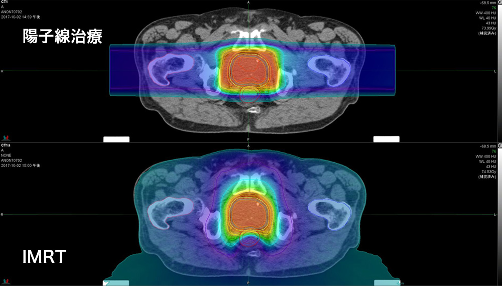 前立腺がんの陽子線治療とIMRTの線量分布